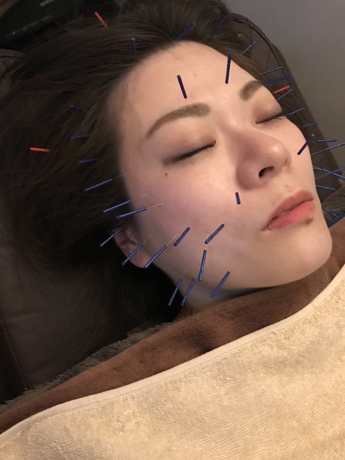 美容鍼
